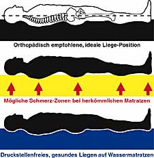 Wasserbett und Rückenleiden
